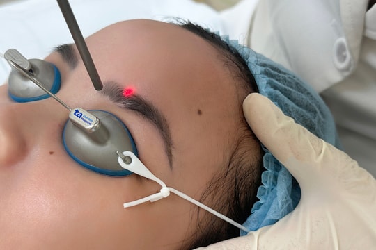 Xóa xăm mày có gây rụng lông không?