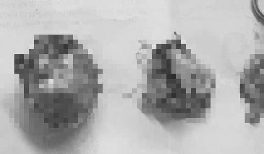 Người phụ nữ 66 tuổi đau bụng kéo dài, bác sĩ gắp ra thứ "đáng sợ"