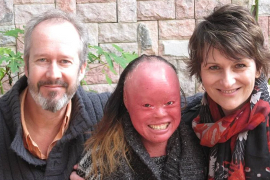 Kỳ tích cuộc đời bé gái mang bệnh 'vảy cá'