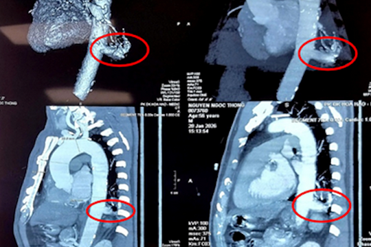 Phần 'phổi thừa' hút máu động mạch chủ người đàn ông suốt 56 năm