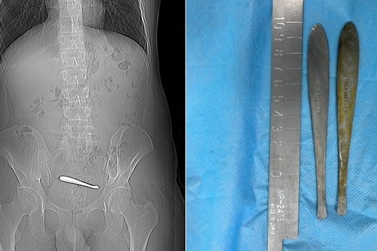 2 chiếc thìa 12 cm kẹt trong ruột chàng trai