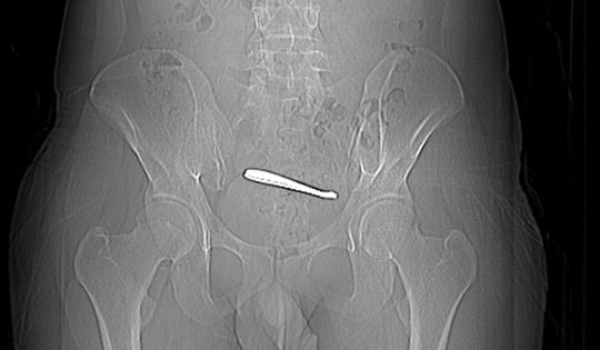 Người đàn ông đau bụng suốt 1 tuần, bác sĩ kiểm tra thì sốc nặng