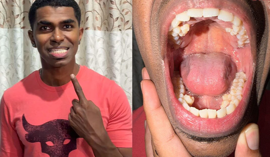 Tưởng mọc răng “bất thường”, chàng trai đi khám và phát hiện mình nắm kỷ lục hiếm có