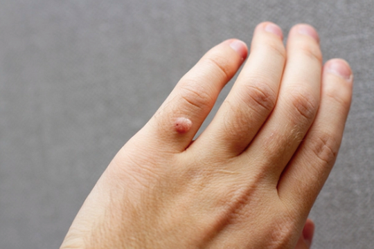 'Hạt cơm' - tổn thương nhỏ có thể lây lan to