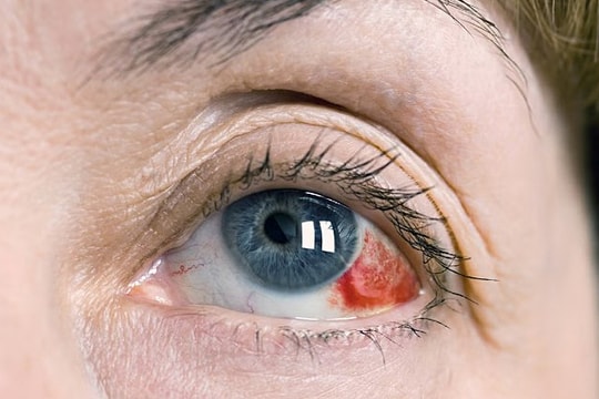 Hôn mê, vỡ mạch máu võng mạc sau chuỗi ngày thức đêm ăn vặt