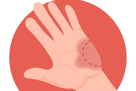 Bị người có nguy cơ bệnh dại gây chảy máu, liệu có nhiễm bệnh?