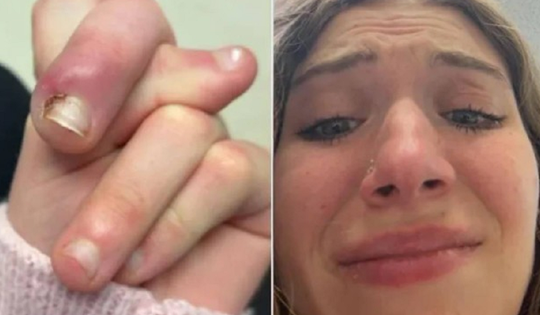 Người phụ nữ 21 tuổi suýt mất ngón vì thói quen "vạn người mê"