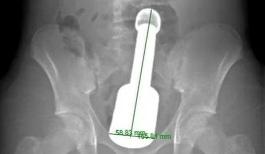 Nam thanh niên 15 tuổi nhập viện vì đau bụng dữ dội, bác sĩ sốc khi phát hiện thứ “đáng sợ” bên trong