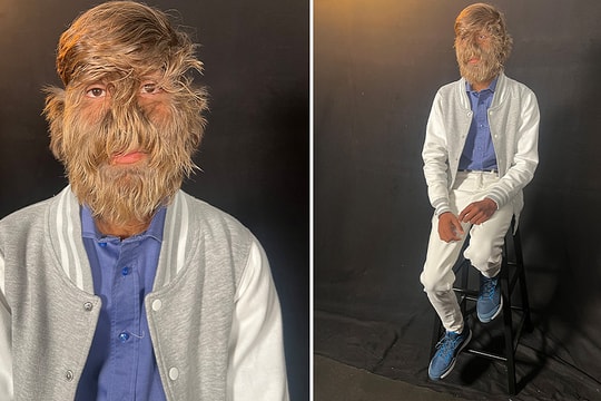 Hội chứng khiến chàng trai có hơn 200 sợi lông trên mỗi cm2 mặt