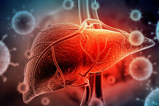 Nguy cơ ung thư từ 'sát thủ thầm lặng' gan nhiễm mỡ
