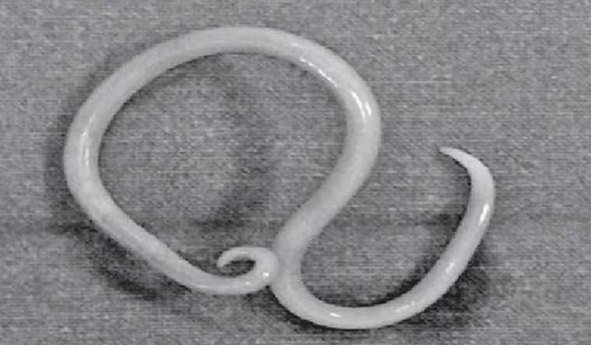 Thiếu niên 15 tuổi bị đau bụng thúc ngược lên, bác sĩ phát hiện "bí mật" đáng sợ bên trong