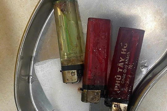 Gắp 3 chiếc bật lửa trong dạ dày người đàn ông