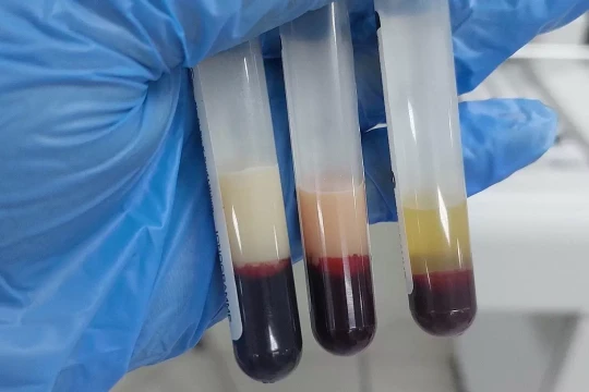 Huyết tương đục như sữa, viêm tụy hoại tử sau chuỗi ngày tiệc tùng