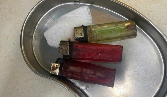 Bác sĩ sốc khi phát hiện 3 chiếc bật lửa trong bụng nam thanh niên