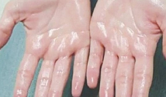 Cách kiểm soát tình trạng ra mồ hôi tay hiệu quả bậc nhất