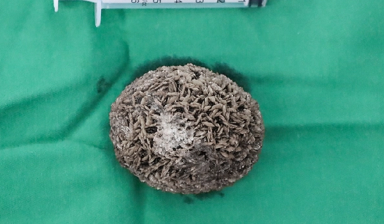 Người đàn ông 50 tuổi đau hạ vị kéo dài, bác sĩ sốc khi gắp ra thứ "đáng sợ" bằng quả trứng ngỗng