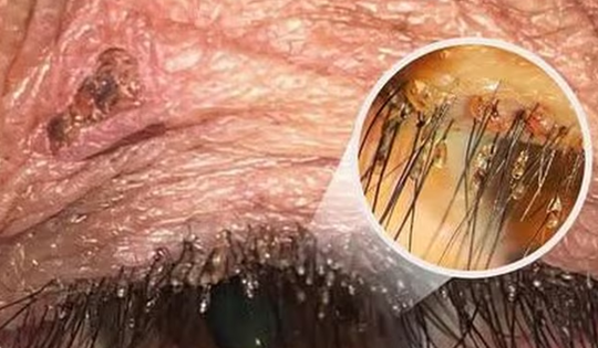 Ngứa mắt khó chịu, người bệnh sốc khi bác sĩ tìm thấy “thủ phạm” ở bờ mi