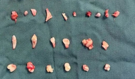 Cô gái đau bụng dữ dội, bác sĩ phát hiện ra bí mật bên trong