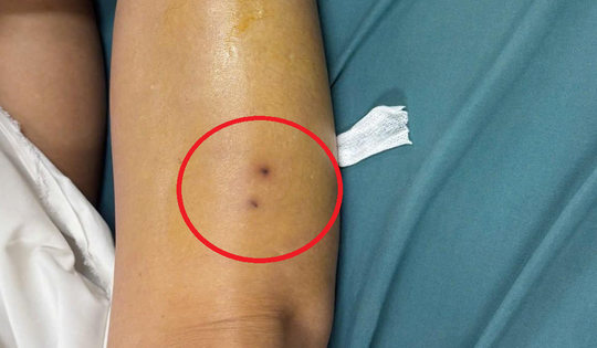 Suýt mất mạng vì rắn độc, người phụ nữ hồi phục thần kỳ sau 1 ngày điều trị