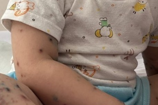 Bộ Y tế cấp phép lưu hành vaccine phòng tay chân miệng