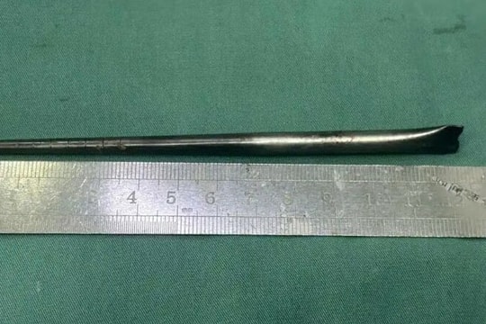 Đũa kim loại 12 cm trong cổ họng người đàn ông suốt 8 năm