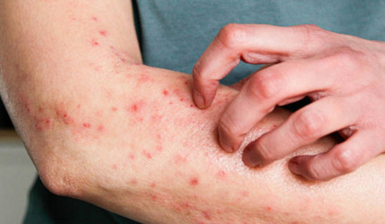 Bộ Y tế yêu cầu không để dịch bệnh viêm màng não mô cầu lan rộng tại cộng đồng