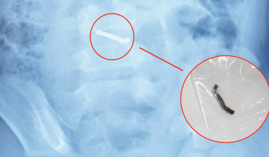 Bé trai 5 tuổi nuốt hàng chục viên nam châm gây thủng ruột