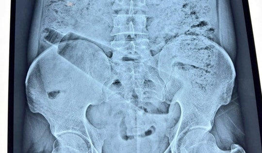 Người đàn ông đau bụng 36 tiếng, bác sĩ phát hiện "bí mật" bên trong