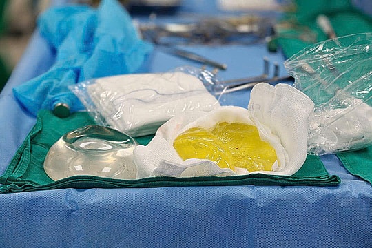 Túi ngực vỡ một năm mới biết