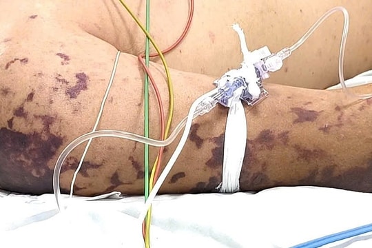 Những thắc mắc thường gặp về não mô cầu