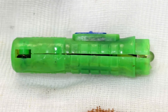 Dị vật hoen gỉ trong cơ thể bé gái suốt 5 tháng