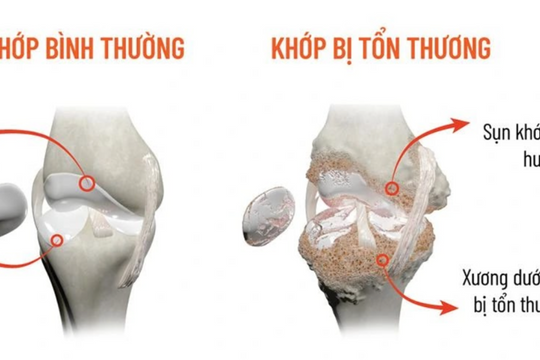 Vì sao khớp kêu lạo xạo?