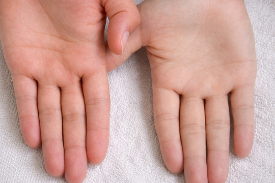 Dấu hiệu cơ thể thiếu sắt