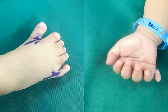 Bé gái có 26 ngón tay chân