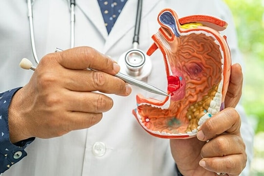 Phát hiện ung thư dạ dày di căn từ khối u ở cổ