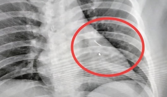 Người đàn ông bị đau ngực, bác sĩ sốc nặng khi phát hiện ra thứ bên trong