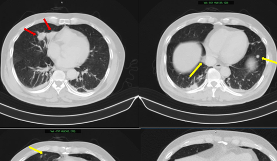 Người đàn ông 63 tuổi sốc nặng khi phát hiện mắc hai bệnh ung thư cùng lúc