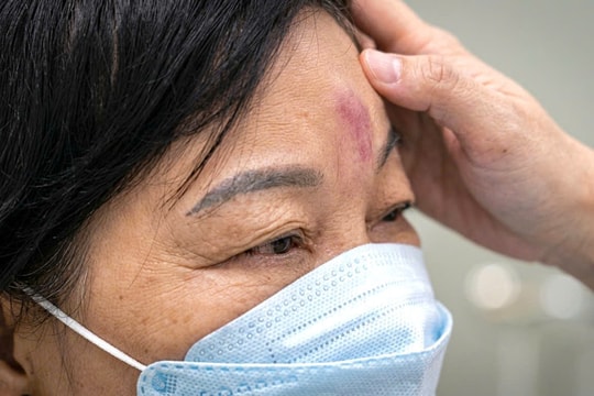 Tiêm filler sai có thể mù mắt vĩnh viễn sau vài phút