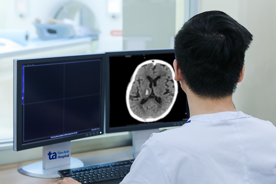 Xuất huyết não do tăng huyết áp