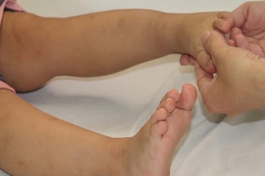 Trẻ nhiễm EV71 triệu chứng tay chân miệng mờ nhạt nhưng nặng nhanh