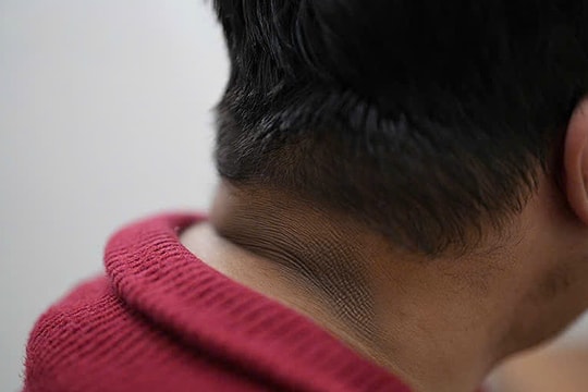 Da cổ, nách sậm màu có phải dấu hiệu tiểu đường?