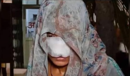 Cãi nhau, chồng cắn vào mũi và má khiến vợ phải khâu 10 mũi