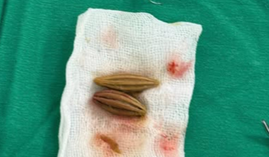 Nuốt nhầm hạt nhót, cụ bà nguy kịch