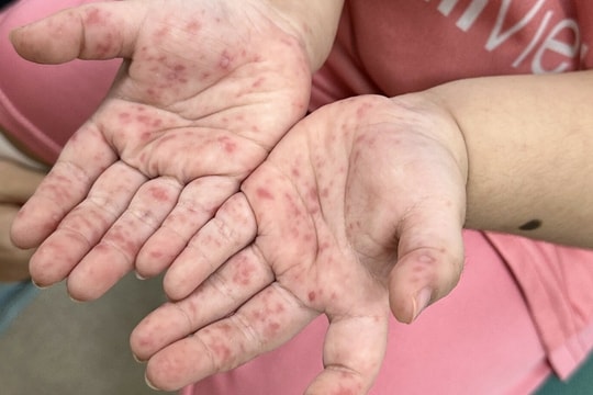 Vì sao trẻ tái mắc tay chân miệng nhiều lần?