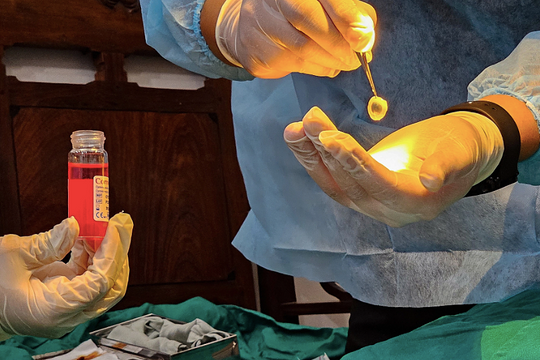 Hơn 500.000 người Việt cần ghép giác mạc