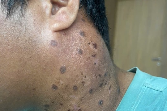 Tưởng cảm xoàng hóa ung thư giai đoạn cuối