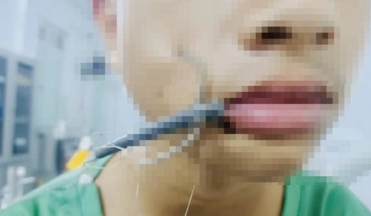 Bé trai 15 tuổi đau dữ dội vùng má, bác sĩ lấy ra thứ "đáng sợ" bên trong