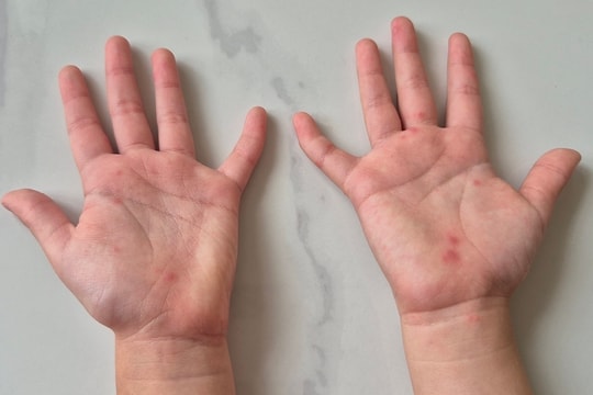 Sai lầm tước đi 'giờ vàng' cứu trẻ tay chân miệng