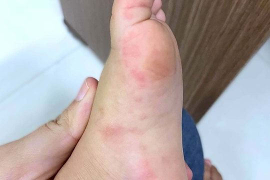 Có nên bôi thuốc vào vết loét của trẻ mắc tay chân miệng?