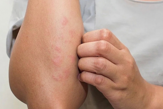 7 triệu chứng âm thầm cảnh báo suy thận